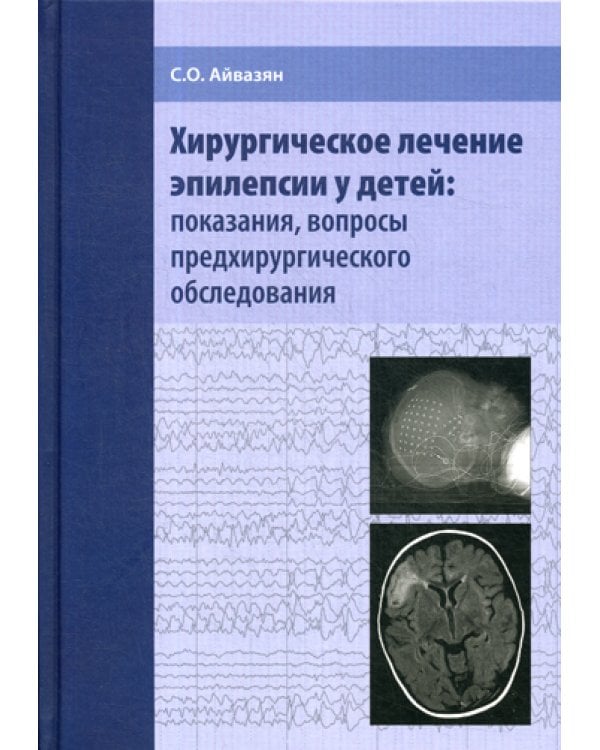 Хирургическое лечение эпилепсии у детей: показания, вопросы предхирургического обследования
