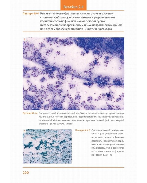 Практическая цитопатология. Интерпретация результатов ТИАБ на основе распознавания паттернов. В 2 т. Т. 2
