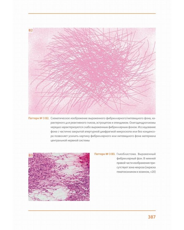 Практическая цитопатология. Интерпретация результатов ТИАБ на основе распознавания паттернов. В 2 т. Т. 2