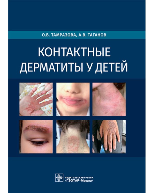 Контактные дерматиты у детей