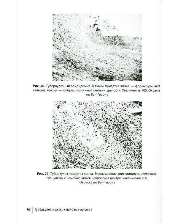 Туберкулез как заболевание, передающееся половым путем: руководство для врачей