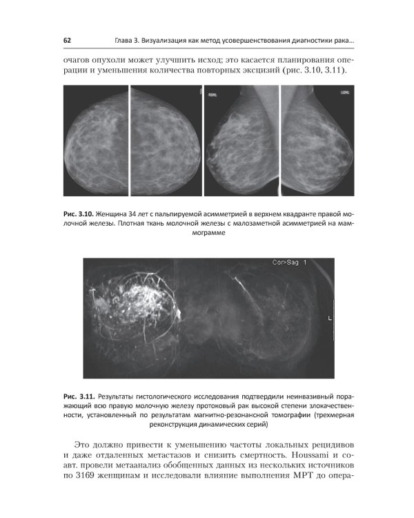 Рак молочной железы у молодых женщин