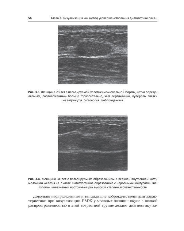 Рак молочной железы у молодых женщин