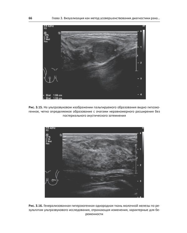 Рак молочной железы у молодых женщин