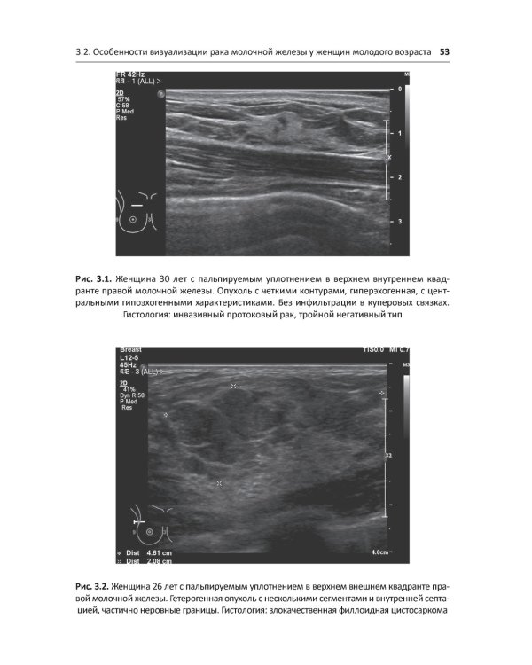 Рак молочной железы у молодых женщин