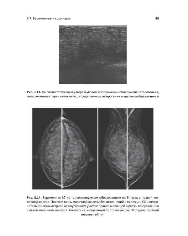 Рак молочной железы у молодых женщин