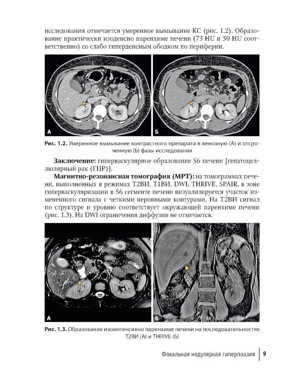 Трудности интерпретации данных КТ и МРТ: печень