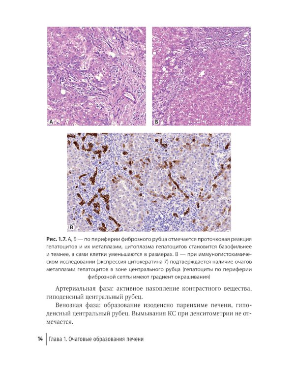 Трудности интерпретации данных КТ и МРТ: печень