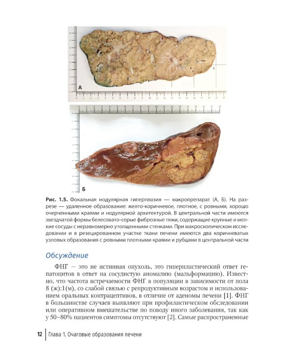 Трудности интерпретации данных КТ и МРТ: печень