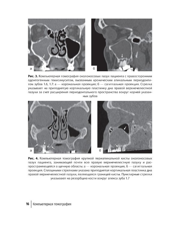 Современные аспекты диагностики и лечения одонтогенного верхнечелюстного синусита: руководство для врачей