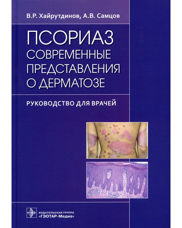 Псориаз. Современные представления о дерматозе: руководство для врачей