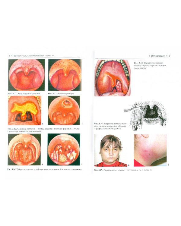 Воспалительные заболевания глотки