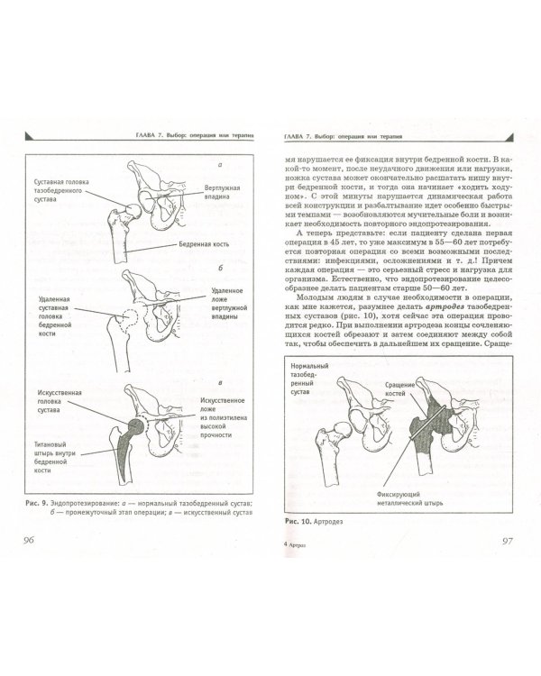Артроз. Избавляемся от болей в суставах