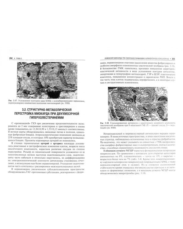 Ишемическая кардиомиопатия