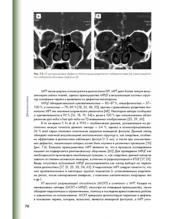 Эндоскопическая диагностика и лечение назальной ликвореи
