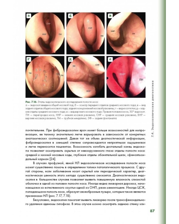 Эндоскопическая диагностика и лечение назальной ликвореи