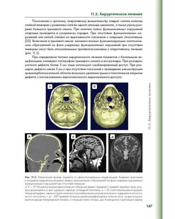 Эндоскопическая диагностика и лечение назальной ликвореи