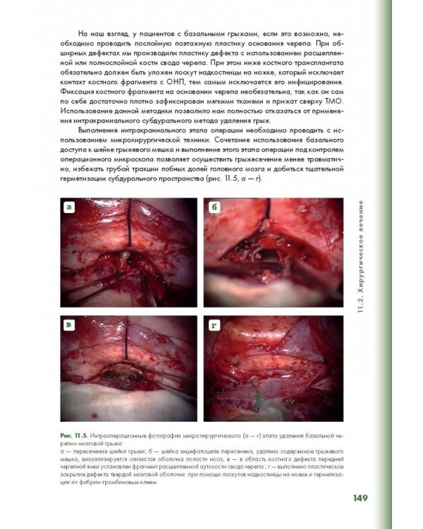 Эндоскопическая диагностика и лечение назальной ликвореи