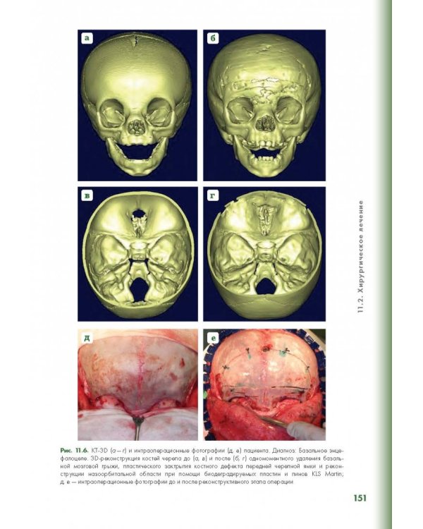 Эндоскопическая диагностика и лечение назальной ликвореи