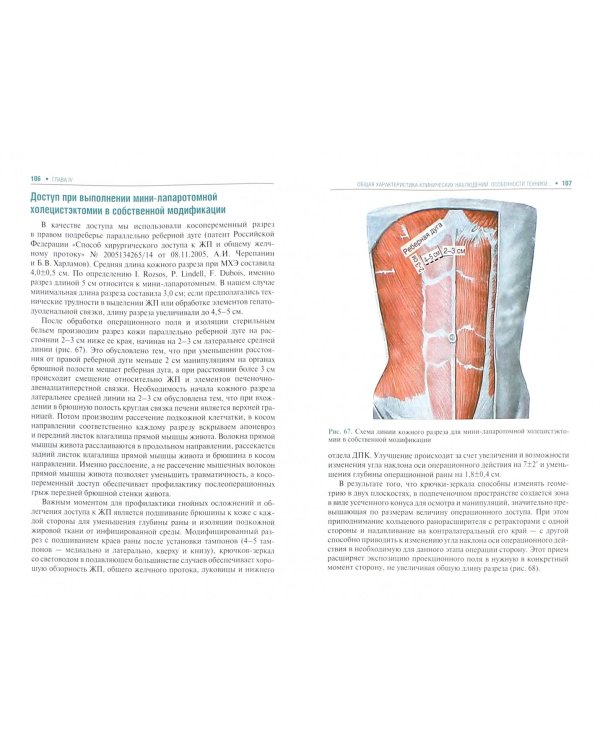 Острый холецистит