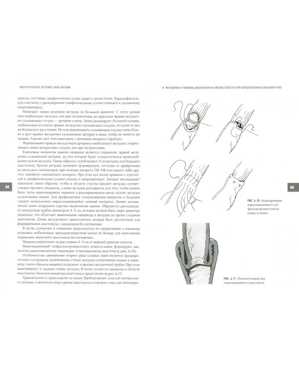 Хирургическое лечение рака кардии