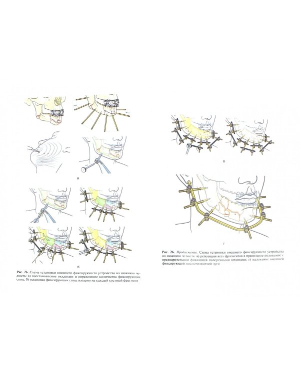 Антибиотикотерапия и антибиотикопрофилактика гнойной инфекции в челюстно-лицевой хирургии