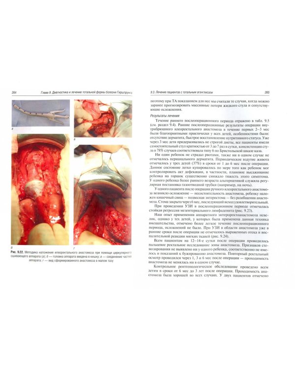 Болезнь Гиршпрунга у детей