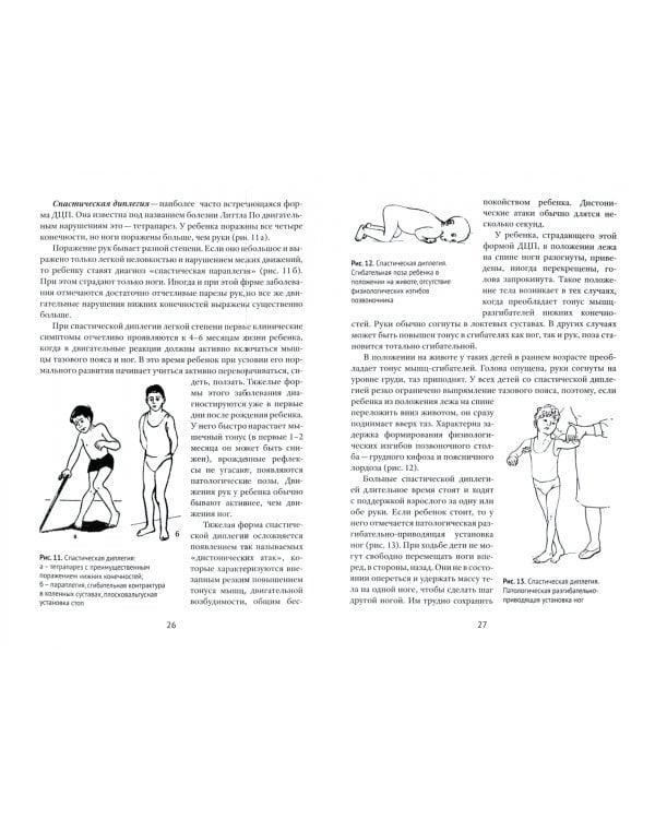 Лечение детских церебральных параличей методами электротерапии