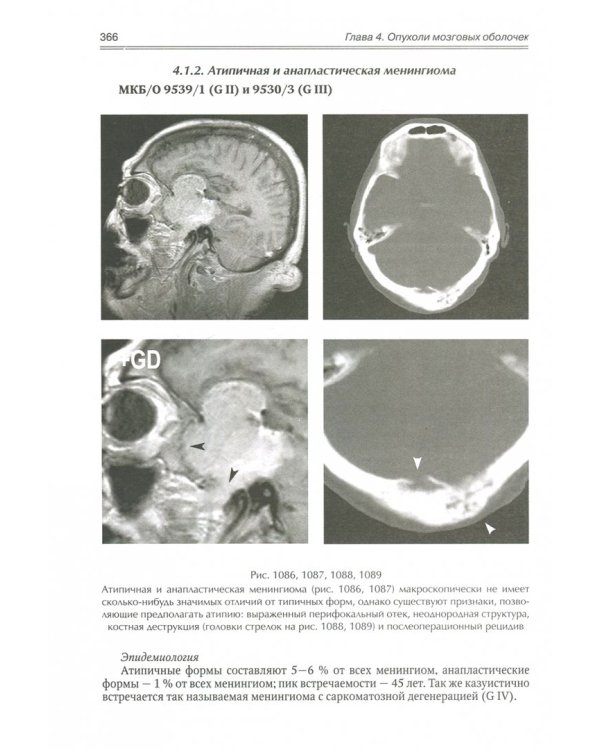 Опухоли мозга КТ- и МРТ- диагностика