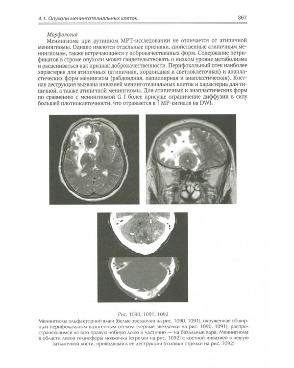 Опухоли мозга КТ- и МРТ- диагностика