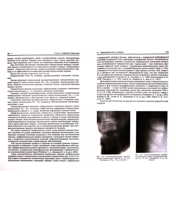 Внелёгочный туберкулёз