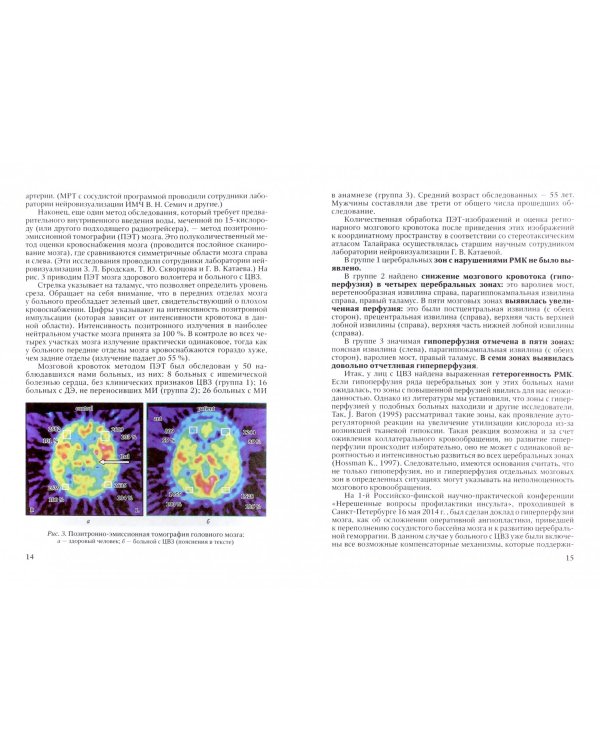 Атеросклероз, гипертония и другие факторы риска как причина сосудистых поражений мозга