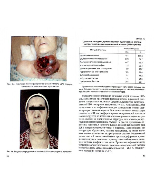 Местно-распространенный рак щитовидной железы. Диагностика, лечение
