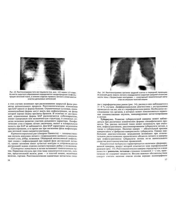 Рентгенологическое исследование при абсцессе легкого. Методические рекомендации