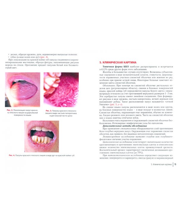 Красный плоский лишай слизистой оболочки полости рта. Руководство