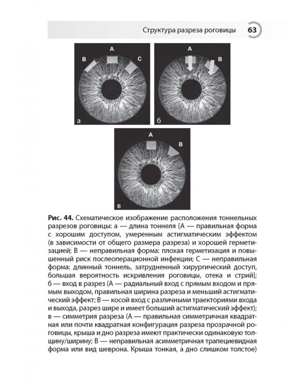 Техника роговичного разреза в хирургии катаракты