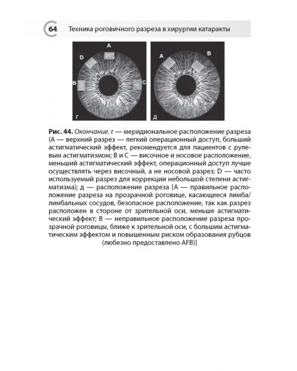 Техника роговичного разреза в хирургии катаракты