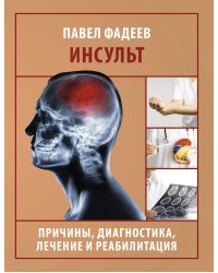 Инсульт. Причины, диагностика, лечение и реабилитация