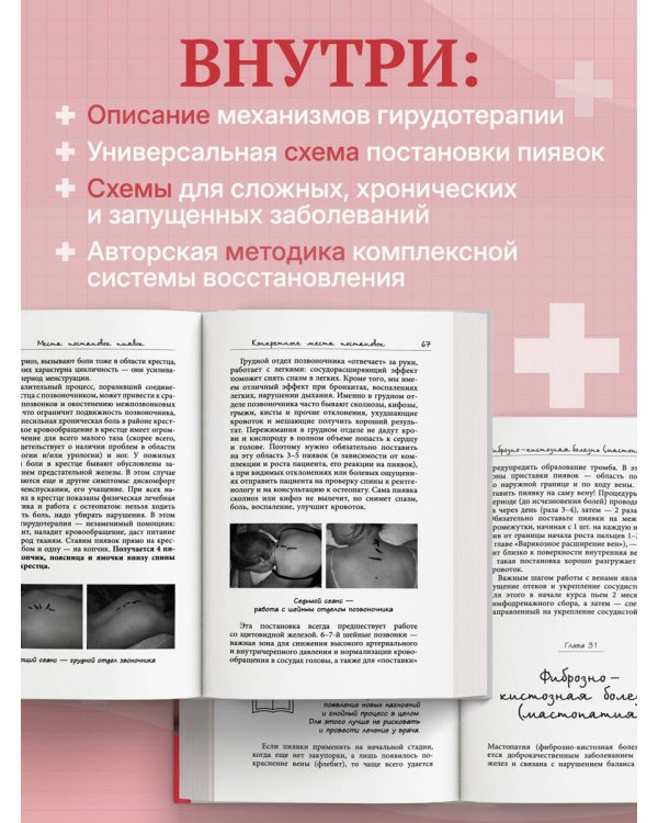 Лечение пиявками. Схемы гирудотерапии при сложных, хронических и запущенных заболеваниях