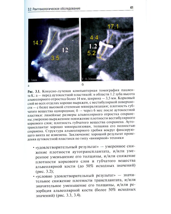 Аутокостная пластика перед выполнением дентальной имплантации: Учебное пособие