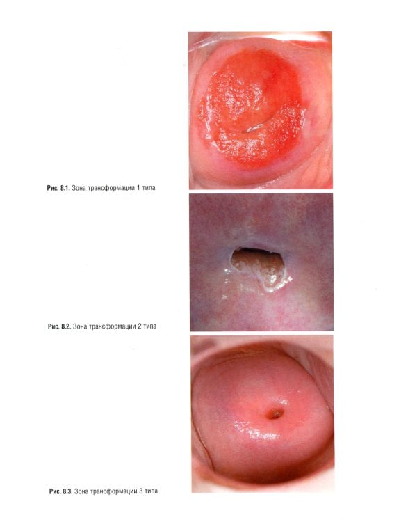 Онкогинекология: национальное руководство