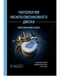 Патология межпозвонкового диска. Поясничный отдел