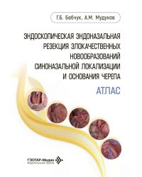 Эндоскопическая эндоназальная резекция злокачественных новообразований синоназальной локализации и основания черепа. Атлас