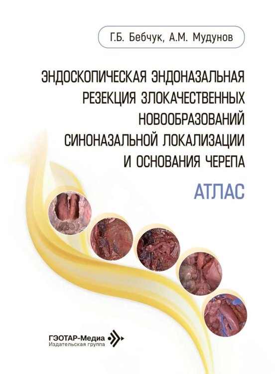 Эндоскопическая эндоназальная резекция злокачественных новообразований синоназальной локализации и основания черепа. Атлас