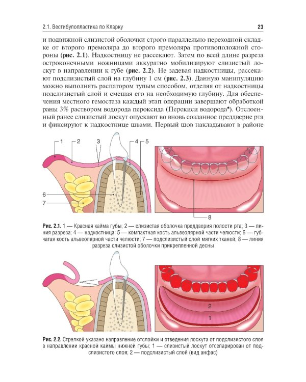 Вестибулопластика: руководство для врачей