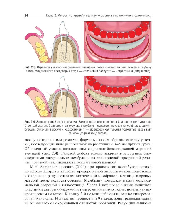 Вестибулопластика: руководство для врачей
