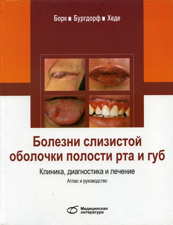 Болезни слизистой оболочки полости рта и губ. Клиника, диагностика и лечение. Атлас и руководство Болезни слизистой оболочки полости рта и губ. Клиника, диагностика и лечение. Атлас и руководство