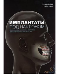 Имплантаты под наклоном. Протезирование с опорой на имплантаты при выраженной атрофии челюстей