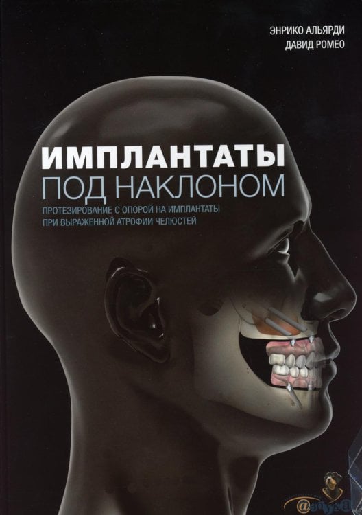 Имплантаты под наклоном. Протезирование с опорой на имплантаты при выраженной атрофии челюстей