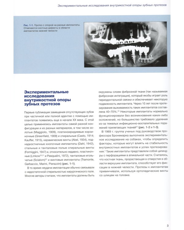 Имплантаты под наклоном. Протезирование с опорой на имплантаты при выраженной атрофии челюстей